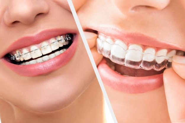 Invisalign-Vs-braces-1024×683