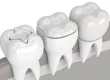 Tooth Colored Fillings