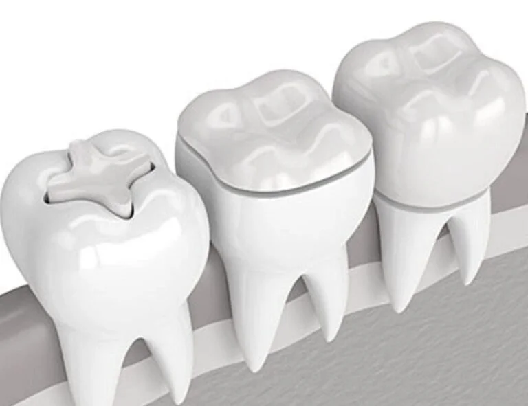 WhatsApp-Image-2022-10-04-at-12.17.18-PM-1-768×591 Tooth Colored Fillings